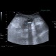 Acute appendicitis, appendicolith: US - Ultrasound